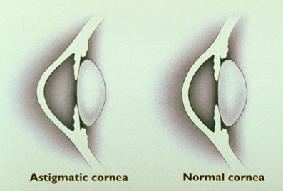 LASIK: The astigmatic eye.