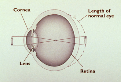 LASIK: The hyperopic eye.