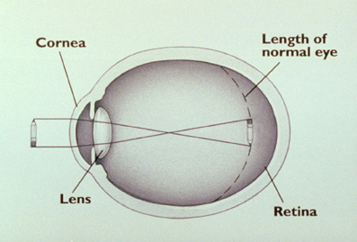 LASIK: The myopic eye.