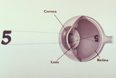 LASIK: The normal, emmetropic, eye.